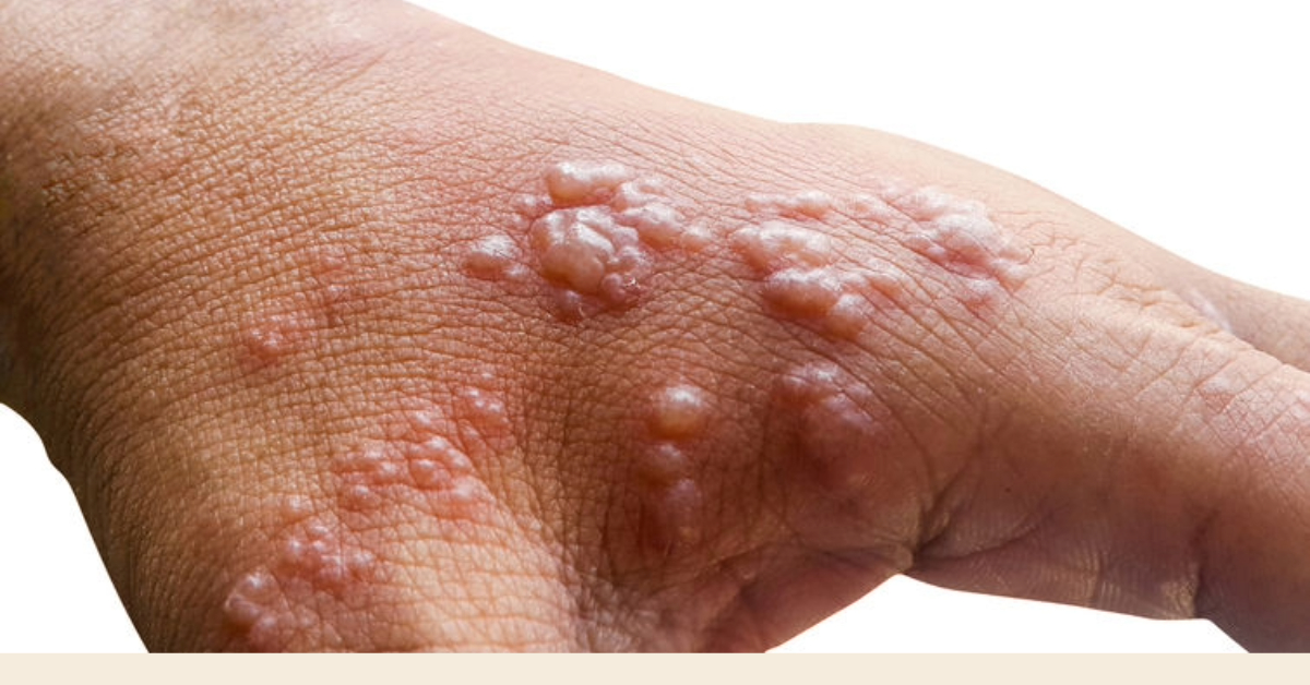Quintana Roo confirms first monkeypox death of 2025 in Cancun
