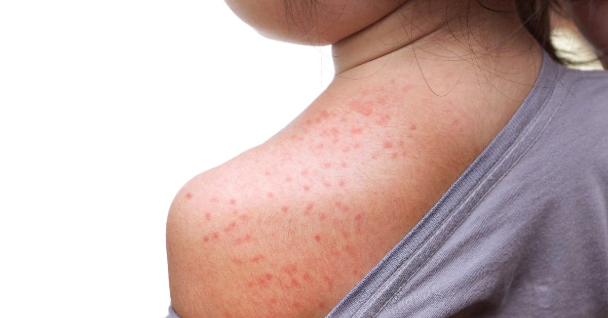 Probable measles case in Aguascalientes triggers alert