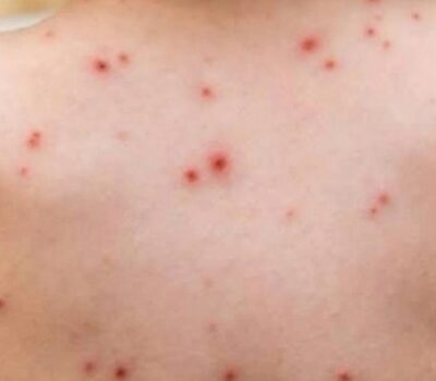 measles jalisco
