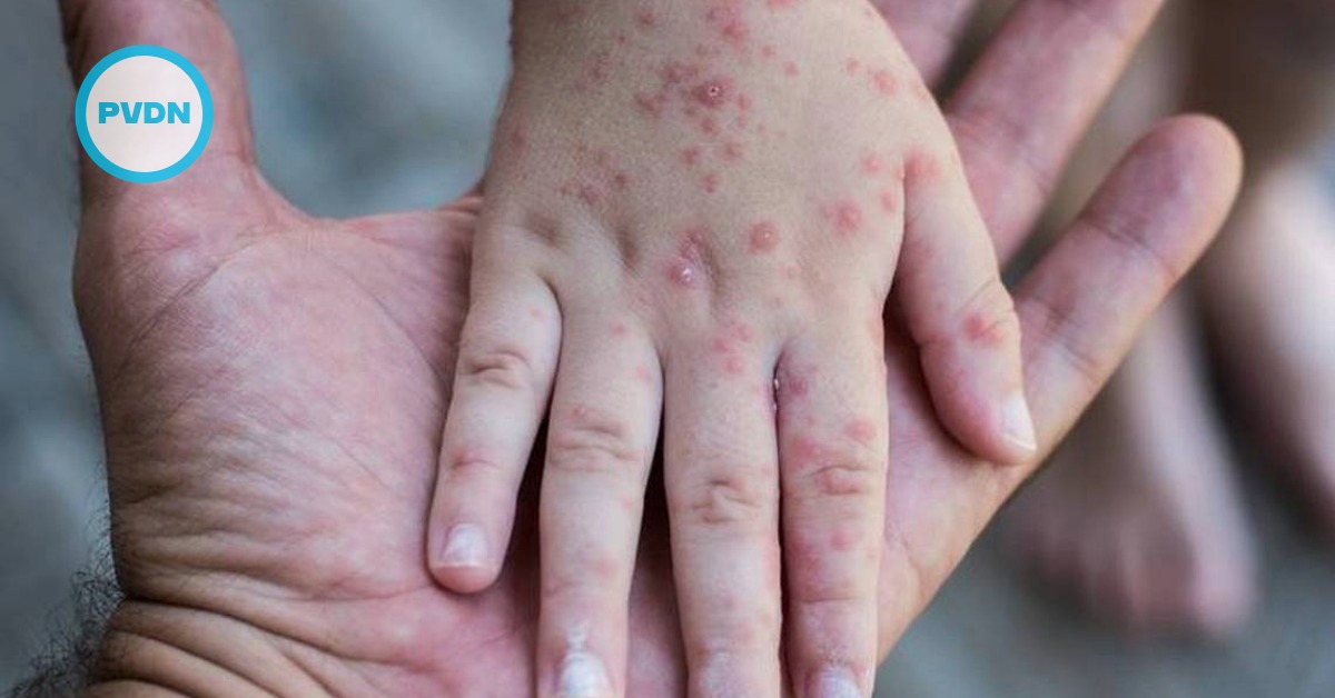 Jalisco measles outbreak